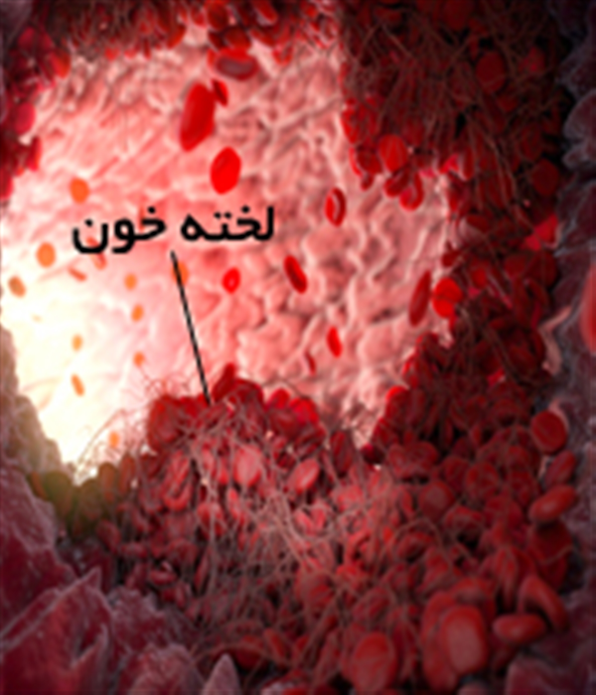 مردان چاق، در خطر ابتلا به لخته‌های خونی