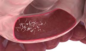 علائم وﺟﻮد اﻧﮕﻞ در بدن چیست؟