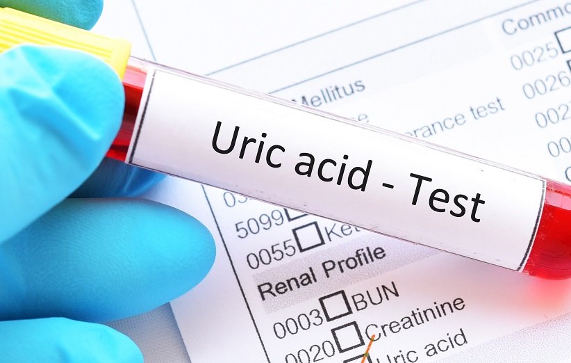 اسيد اوريک و ديابت نوع دو