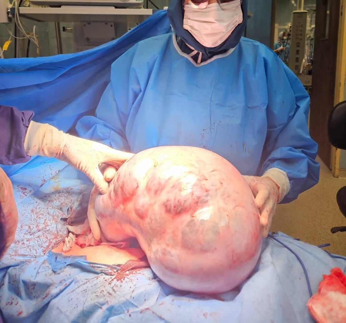 خارج کردن توده ۱۰ کیلویی از شکم بیمار در کرج