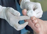 پیشگیری از بروز زخم پای دیابتی، همزمان با شیوع دیابت